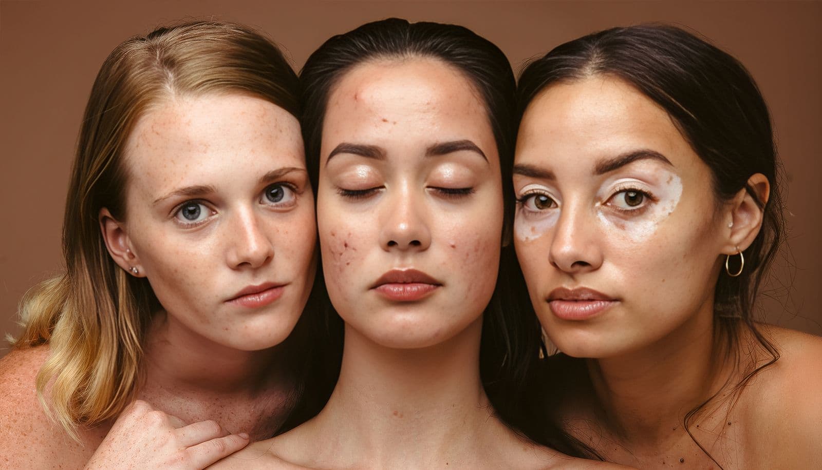 What Are the Types of Skin Spots?